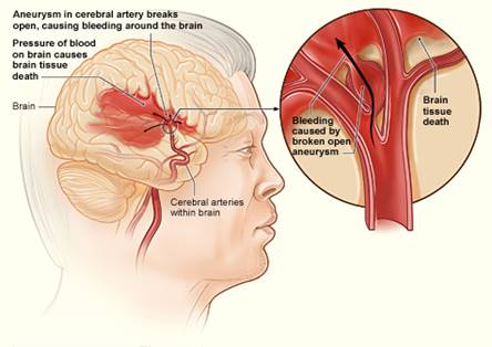 Image result for stroke brain