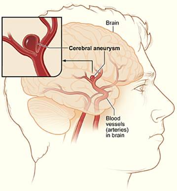 Image result for subarachnoid hemorrhage