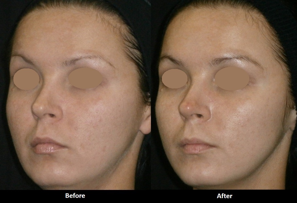 IPL Photofacial (Laser Procedure)