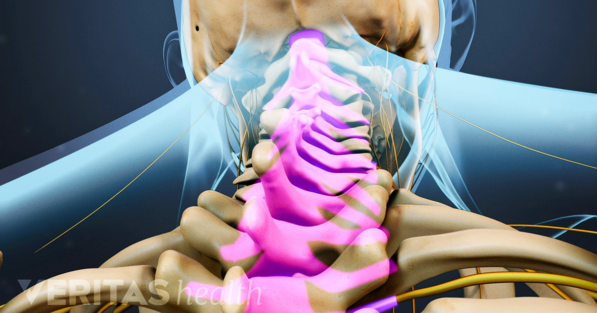 Melva Mitchell Forth Worth Spinal Column