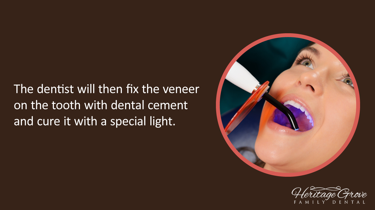 Porcelain Veneers The Procedure At A Glance