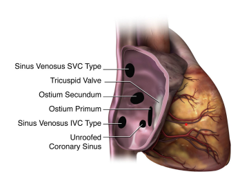 Types of atrial septal defects