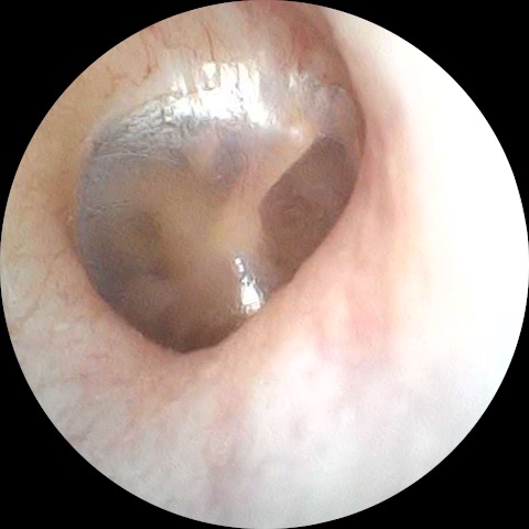 earwax removal after