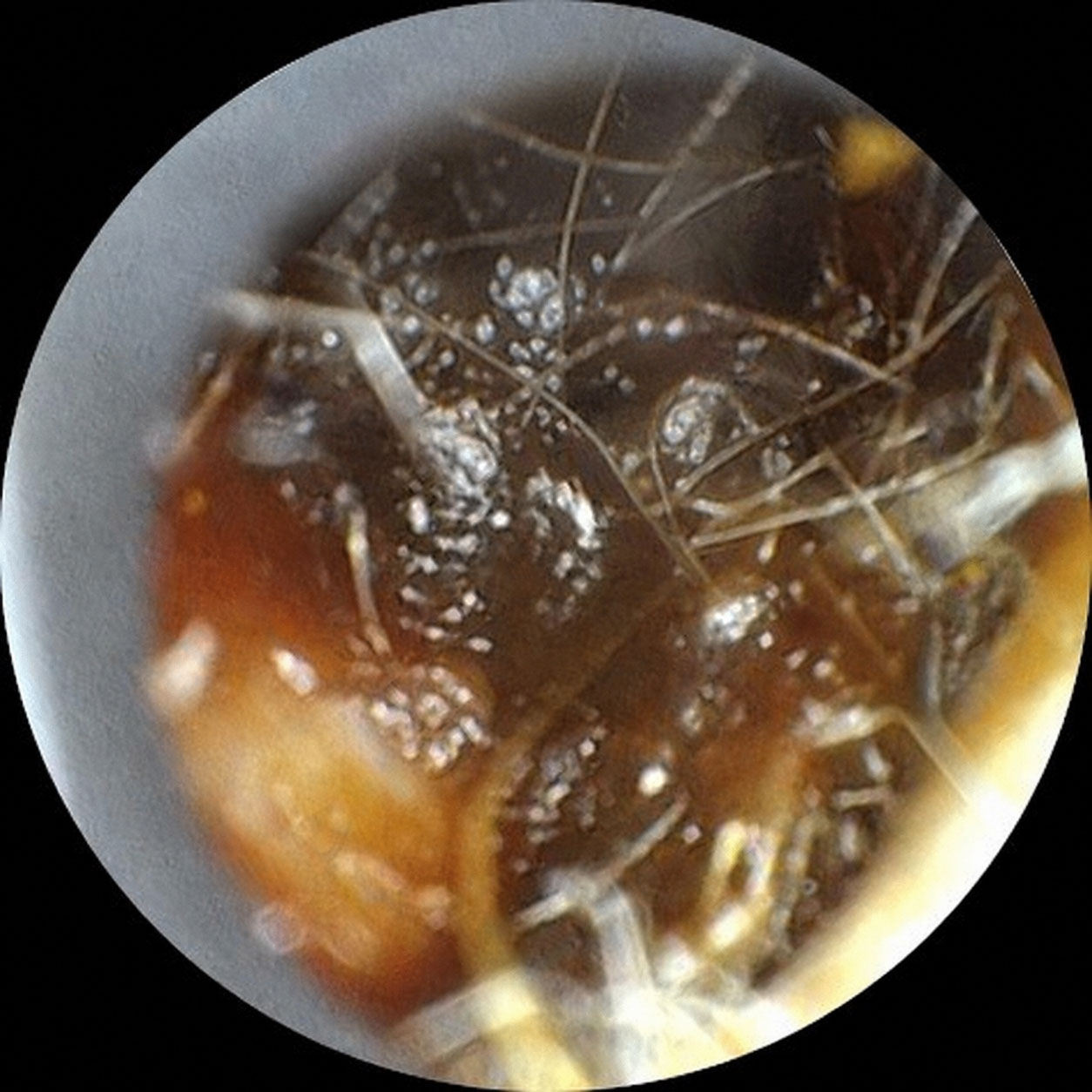 earwax removal before