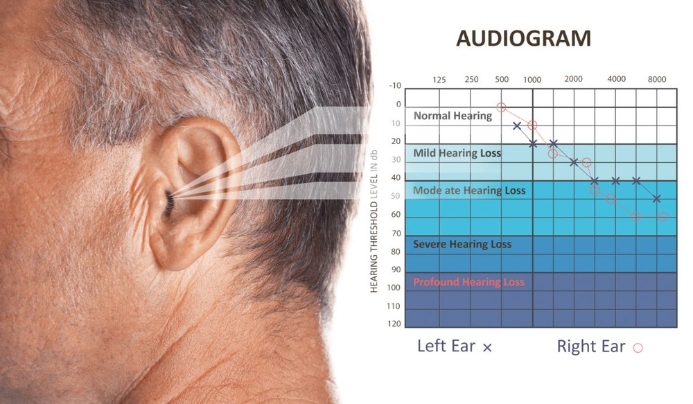 audiogram 1