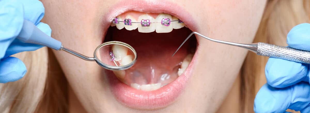 Orthodontic Evaluation for my child