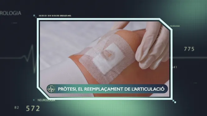 LA PROTÈSI, EL REEMPLAÇAMENT DE L'ARTICULACIÓ