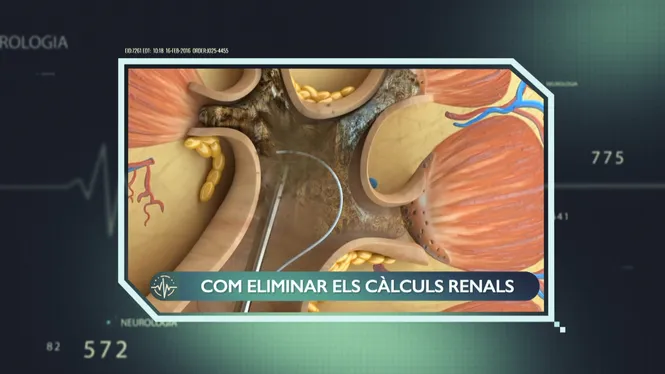 CÀLCULS RENALS, MÉS QUE PEDRES EN EL CAMÍ