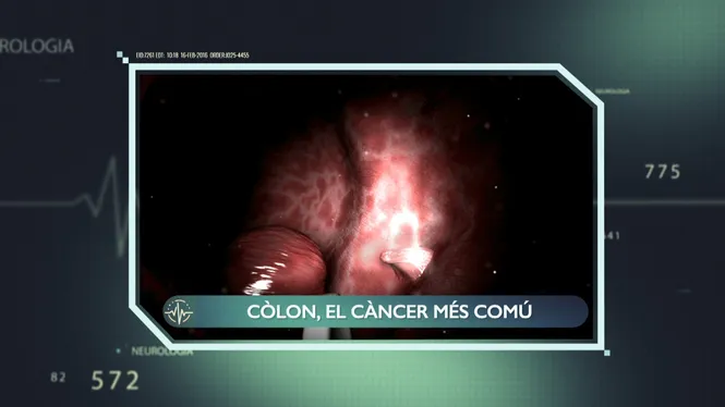 CÀNCER DE COLON, EL TUMOR MÉS COMÚ