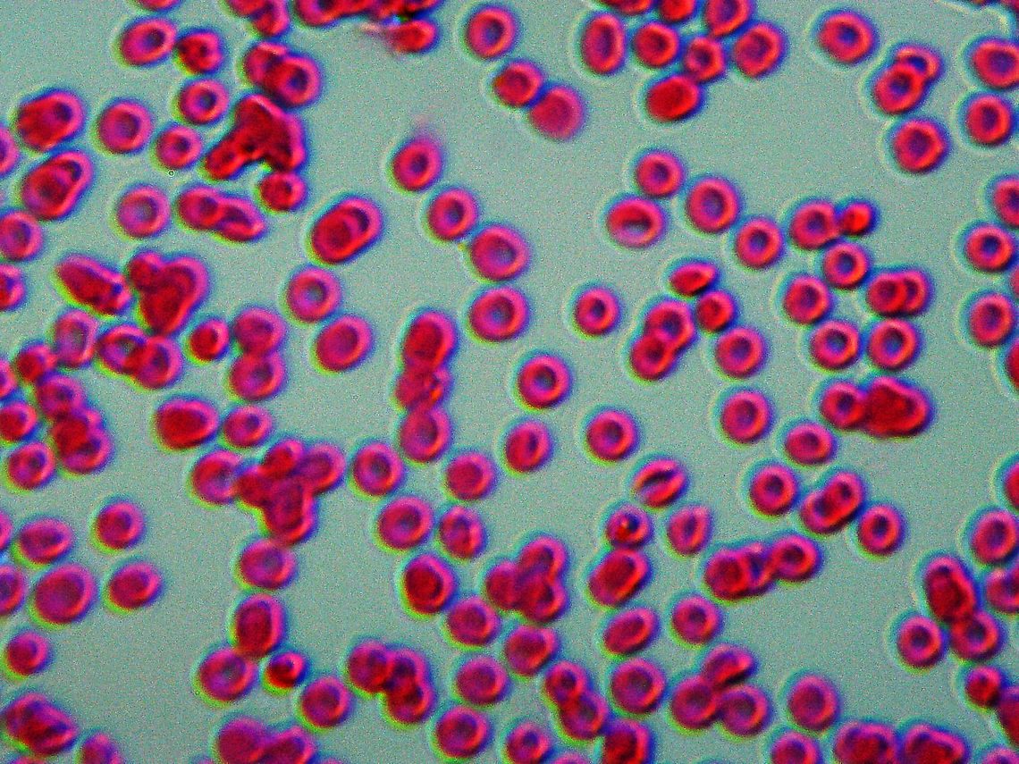 Plasmodium falciparum Smear This species of Plasmodium causes the most severe form of malaria (human malignant tertian malaria). The slide is of an infected blood smear. <br />
<br />
Malarial symptoms include severe fever and chills, blood vessel blockage, and death. Malaria is transmitted by mosquitoes in the Anopheles genus. Geotagged,Plasmodium falciparum,Protozoa,United States,Winter,human malignant tertian malaria,malaria,plasmodium