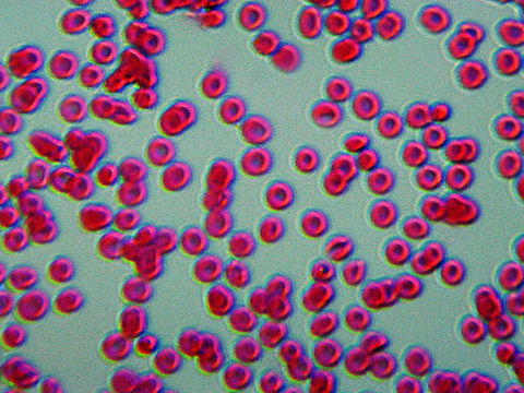 Plasmodium falciparum Smear This species of Plasmodium causes the most severe form of malaria (human malignant tertian malaria). The slide is of an infected blood smear. 

Malarial symptoms include severe fever and chills, blood vessel blockage, and death. Malaria is transmitted by mosquitoes in the Anopheles genus. Geotagged,Plasmodium falciparum,Protozoa,United States,Winter,human malignant tertian malaria,malaria,plasmodium