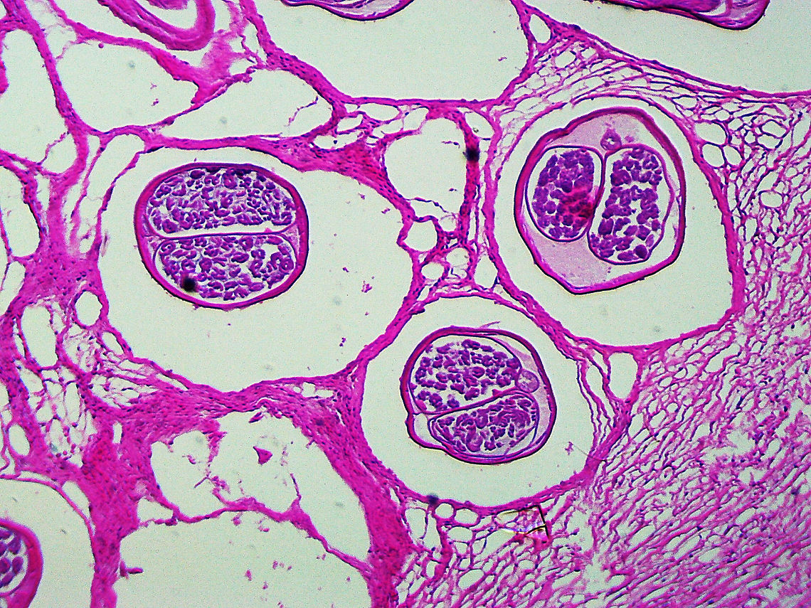 Onchocherca volvulus Onchocherca volvulus is a nematode that causes onchocerciasis (river blindness). It is a leading cause of blindness and is transmitted by blackflies (Simulium sp.). It is especially problematic in sub-Saharan Africa. Humans are the only known host.<br />
<br />
This slide shows the cross-section of female nematodes. The surrounding tissues are from the host.<br />
<br />
If you are unfamiliar with the manifestation of illness that this parasite causes, check out this link: <br />
<a href="https://s160131.gridserver.com/wp-content/uploads/2013/04/5634399336_8737e9fb2b_o.jpg" rel="nofollow">https://s160131.gridserver.com/wp-content/uploads/2013/04/5634399336_8737e9fb2b_o.jpg</a> <br />
<br />
<figure class="photo"><a href="https://www.jungledragon.com/image/110860/onchocherca_volvulus.html" title="Onchocherca volvulus"><img src="https://s3.amazonaws.com/media.jungledragon.com/images/3232/110860_thumb.jpg?AWSAccessKeyId=05GMT0V3GWVNE7GGM1R2&Expires=1759968010&Signature=f3ICn%2BdmbDwHQ9%2BAe6KjRC3%2BMac%3D" width="200" height="146" alt="Onchocherca volvulus Onchocherca volvulus is a nematode that causes onchocerciasis (river blindness). It is a leading cause of blindness and is transmitted by blackflies (Simulium sp.). It is especially problematic in sub-Saharan Africa. Humans are the only known host.<br />
<br />
This slide shows the cross-section of female nematodes. The surrounding tissues are from the host.<br />
<br />
If you are unfamiliar with the manifestation of illness that this parasite causes, check out this link:<br />
https://s160131.gridserver.com/wp-content/uploads/2013/04/5634399336_8737e9fb2b_o.jpg<br />
<br />
https://www.jungledragon.com/image/110859/onchocherca_volvulus.html Geotagged,Onchocerca volvulus,Onchocherca Volvulus,Summer" /></a></figure> Geotagged,Onchocerca volvulus,Onchocherca,Onchocherca Volvulus,United States,Winter,nematode,onchocerciasis,river blindness