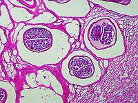 Onchocherca volvulus Onchocherca volvulus is a nematode that causes onchocerciasis (river blindness). It is a leading cause of blindness and is transmitted by blackflies (Simulium sp.). It is especially problematic in sub-Saharan Africa. Humans are the only known host.<br />
<br />
This slide shows the cross-section of female nematodes. The surrounding tissues are from the host.<br />
<br />
If you are unfamiliar with the manifestation of illness that this parasite causes, check out this link: <br />
https://s160131.gridserver.com/wp-content/uploads/2013/04/5634399336_8737e9fb2b_o.jpg <br />
<br />
https://www.jungledragon.com/image/110860/onchocherca_volvulus.html Geotagged,Onchocerca volvulus,Onchocherca,Onchocherca Volvulus,United States,Winter,nematode,onchocerciasis,river blindness