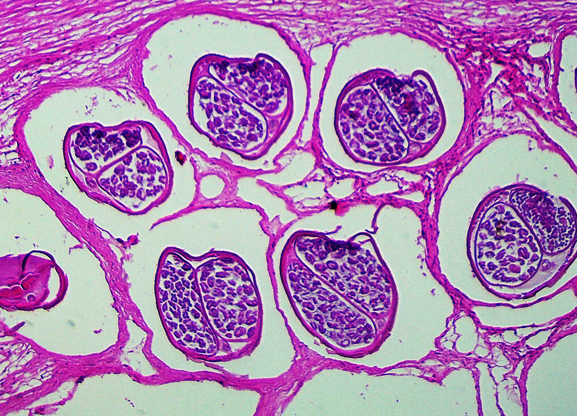 Onchocherca volvulus Onchocherca volvulus is a nematode that causes onchocerciasis (river blindness). It is a leading cause of blindness and is transmitted by blackflies (Simulium sp.). It is especially problematic in sub-Saharan Africa. Humans are the only known host.<br />
<br />
This slide shows the cross-section of female nematodes. The surrounding tissues are from the host.<br />
<br />
If you are unfamiliar with the manifestation of illness that this parasite causes, check out this link:<br />
<a href="https://s160131.gridserver.com/wp-content/uploads/2013/04/5634399336_8737e9fb2b_o.jpg" rel="nofollow">https://s160131.gridserver.com/wp-content/uploads/2013/04/5634399336_8737e9fb2b_o.jpg</a><br />
<br />
<figure class="photo"><a href="https://www.jungledragon.com/image/110859/onchocherca_volvulus.html" title="Onchocherca volvulus"><img src="https://s3.amazonaws.com/media.jungledragon.com/images/3232/110859_thumb.jpg?AWSAccessKeyId=05GMT0V3GWVNE7GGM1R2&Expires=1759968010&Signature=fak9c4YEs%2BiI4WGNd9zpximKrJA%3D" width="200" height="150" alt="Onchocherca volvulus Onchocherca volvulus is a nematode that causes onchocerciasis (river blindness). It is a leading cause of blindness and is transmitted by blackflies (Simulium sp.). It is especially problematic in sub-Saharan Africa. Humans are the only known host.<br />
<br />
This slide shows the cross-section of female nematodes. The surrounding tissues are from the host.<br />
<br />
If you are unfamiliar with the manifestation of illness that this parasite causes, check out this link: <br />
https://s160131.gridserver.com/wp-content/uploads/2013/04/5634399336_8737e9fb2b_o.jpg <br />
<br />
https://www.jungledragon.com/image/110860/onchocherca_volvulus.html Geotagged,Onchocerca volvulus,Onchocherca,Onchocherca Volvulus,United States,Winter,nematode,onchocerciasis,river blindness" /></a></figure> Geotagged,Onchocerca volvulus,Onchocherca Volvulus,Summer