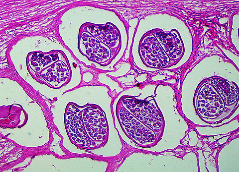 Onchocherca volvulus Onchocherca volvulus is a nematode that causes onchocerciasis (river blindness). It is a leading cause of blindness and is transmitted by blackflies (Simulium sp.). It is especially problematic in sub-Saharan Africa. Humans are the only known host.

This slide shows the cross-section of female nematodes. The surrounding tissues are from the host.

If you are unfamiliar with the manifestation of illness that this parasite causes, check out this link:
https://s160131.gridserver.com/wp-content/uploads/2013/04/5634399336_8737e9fb2b_o.jpg

https://www.jungledragon.com/image/110859/onchocherca_volvulus.html Geotagged,Onchocerca volvulus,Onchocherca Volvulus,Summer