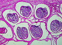 Onchocherca volvulus Onchocherca volvulus is a nematode that causes onchocerciasis (river blindness). It is a leading cause of blindness and is transmitted by blackflies (Simulium sp.). It is especially problematic in sub-Saharan Africa. Humans are the only known host.<br />
<br />
This slide shows the cross-section of female nematodes. The surrounding tissues are from the host.<br />
<br />
If you are unfamiliar with the manifestation of illness that this parasite causes, check out this link:<br />
https://s160131.gridserver.com/wp-content/uploads/2013/04/5634399336_8737e9fb2b_o.jpg<br />
<br />
https://www.jungledragon.com/image/110859/onchocherca_volvulus.html Geotagged,Onchocerca volvulus,Onchocherca Volvulus,Summer