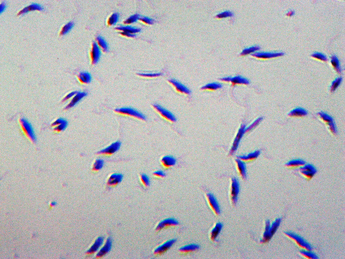 Leishmania donovani Kinetoplastids Leishmania donovani  is an intracellular parasite that causes visceral leishmaniasis (kala-azar), which is the most severe form of leishmaniasis. It infects the spleen, liver, and bone marrow with humans as the definitive host. It&#039;s transmitted by sandflies in the genus Phlebotomus in Old World (and Lutzomyia in New World). <br />
<br />
Visceral leishmaniasis affects more than 100 million people worldwide, with 500,000 new cases and more than 50,000 deaths each year. It is fatal to humans. Treatment can be difficult because of drug resistance in patients, emerging strains of the parasite, and the toxicity of treatment. The drug miltefosine is highly effective (95% cure rate)  in treating cases of leishmaniasis in India. I&#039;m not sure of its efficacy against African strains.<br />
<br />
(Slide is a smear) Geotagged,Leishmania,Leishmania donovani,Leishmaniasis,United States,Winter,kala azar,kinetoplastids,parasite,sandfly,visceral leishmaniasis