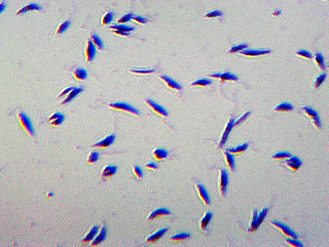 Leishmania donovani Kinetoplastids Leishmania donovani  is an intracellular parasite that causes visceral leishmaniasis (kala-azar), which is the most severe form of leishmaniasis. It infects the spleen, liver, and bone marrow with humans as the definitive host. It's transmitted by sandflies in the genus Phlebotomus in Old World (and Lutzomyia in New World). 

Visceral leishmaniasis affects more than 100 million people worldwide, with 500,000 new cases and more than 50,000 deaths each year. It is fatal to humans. Treatment can be difficult because of drug resistance in patients, emerging strains of the parasite, and the toxicity of treatment. The drug miltefosine is highly effective (95% cure rate)  in treating cases of leishmaniasis in India. I'm not sure of its efficacy against African strains.

(Slide is a smear) Geotagged,Leishmania,Leishmania donovani,Leishmaniasis,United States,Winter,kala azar,kinetoplastids,parasite,sandfly,visceral leishmaniasis