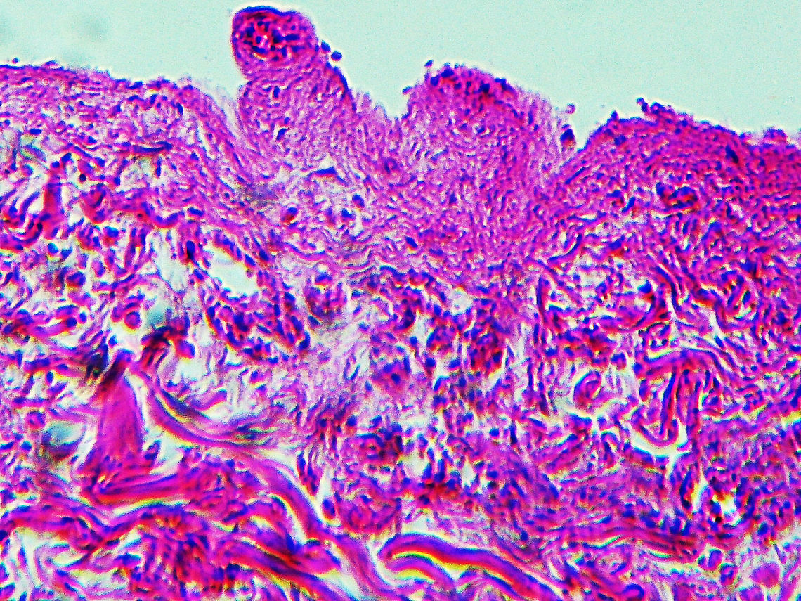 Rocky Mountain Spotted Fever (RMSF) - Rickettsia rickettsii This slide is a skin biopsy from a person infected with Rickettsia rickettsii (the causative agent of Rocky Mountain Spotted Fever). It shows necrosis, vasculitis, and inflammation. <br />
<figure class="photo"><a href="https://www.jungledragon.com/image/114303/rocky_mountain_spotted_fever_rmsf_-_rickettsia_rickettsii.html" title="Rocky Mountain Spotted Fever (RMSF) - Rickettsia rickettsii"><img src="https://s3.amazonaws.com/media.jungledragon.com/images/3232/114303_thumb.jpg?AWSAccessKeyId=05GMT0V3GWVNE7GGM1R2&Expires=1759968010&Signature=nw1uuResD62KpQXD9uxeHQkk%2FnM%3D" width="200" height="150" alt="Rocky Mountain Spotted Fever (RMSF) - Rickettsia rickettsii This slide is a skin biopsy from a person infected with Rickettsia rickettsii (the causative agent of Rocky Mountain Spotted Fever). It shows necrosis, vasculitis, and inflammation.<br />
<br />
RMSF is a serious, life-threatening tick-borne disease. It&#039;s often misdiagnosed. A classic RMSF symptom is a rash, which occurs in about 90% of patients. The disease was first identified in the Rocky Mountains, but can also be found in parts of Canada, Mexico, as well as South and Central America.<br />
https://www.jungledragon.com/image/114302/rocky_mountain_spotted_fever_rmsf_-_rickettsia_rickettsii.html Geotagged,Rickettsia rickettsii,United States,Winter" /></a></figure><br />
<br />
RMSF is a serious, life-threatening tick-borne disease. It&#039;s often misdiagnosed. A classic RMSF symptom is a rash, which occurs in about 90% of patients.  The disease was first identified in the Rocky Mountains, but can also be found in parts of Canada, Mexico, as well as South and Central America. Geotagged,RMSF,Rickettsia,Rickettsia rickettsii,Rocky Mountain Spotted Fever,United States,Winter,bacteria,pathogen,tick-borne disease