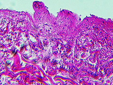 Rocky Mountain Spotted Fever (RMSF) - Rickettsia rickettsii This slide is a skin biopsy from a person infected with Rickettsia rickettsii (the causative agent of Rocky Mountain Spotted Fever). It shows necrosis, vasculitis, and inflammation. 
https://www.jungledragon.com/image/114303/rocky_mountain_spotted_fever_rmsf_-_rickettsia_rickettsii.html

RMSF is a serious, life-threatening tick-borne disease. It's often misdiagnosed. A classic RMSF symptom is a rash, which occurs in about 90% of patients.  The disease was first identified in the Rocky Mountains, but can also be found in parts of Canada, Mexico, as well as South and Central America. Geotagged,RMSF,Rickettsia,Rickettsia rickettsii,Rocky Mountain Spotted Fever,United States,Winter,bacteria,pathogen,tick-borne disease