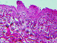 Rocky Mountain Spotted Fever (RMSF) - Rickettsia rickettsii This slide is a skin biopsy from a person infected with Rickettsia rickettsii (the causative agent of Rocky Mountain Spotted Fever). It shows necrosis, vasculitis, and inflammation. <br />
https://www.jungledragon.com/image/114303/rocky_mountain_spotted_fever_rmsf_-_rickettsia_rickettsii.html<br />
<br />
RMSF is a serious, life-threatening tick-borne disease. It's often misdiagnosed. A classic RMSF symptom is a rash, which occurs in about 90% of patients.  The disease was first identified in the Rocky Mountains, but can also be found in parts of Canada, Mexico, as well as South and Central America. Geotagged,RMSF,Rickettsia,Rickettsia rickettsii,Rocky Mountain Spotted Fever,United States,Winter,bacteria,pathogen,tick-borne disease
