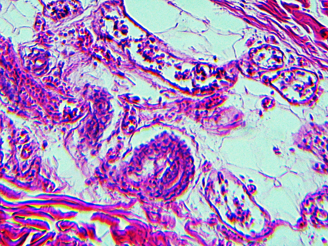 Rocky Mountain Spotted Fever (RMSF) - Rickettsia rickettsii This slide is a skin biopsy from a person infected with Rickettsia rickettsii (the causative agent of Rocky Mountain Spotted Fever). It shows necrosis, vasculitis, and inflammation.<br />
<br />
RMSF is a serious, life-threatening tick-borne disease. It&#039;s often misdiagnosed. A classic RMSF symptom is a rash, which occurs in about 90% of patients. The disease was first identified in the Rocky Mountains, but can also be found in parts of Canada, Mexico, as well as South and Central America.<br />
<figure class="photo"><a href="https://www.jungledragon.com/image/114302/rocky_mountain_spotted_fever_rmsf_-_rickettsia_rickettsii.html" title="Rocky Mountain Spotted Fever (RMSF) - Rickettsia rickettsii"><img src="https://s3.amazonaws.com/media.jungledragon.com/images/3232/114302_thumb.jpg?AWSAccessKeyId=05GMT0V3GWVNE7GGM1R2&Expires=1759968010&Signature=gqeqHkIWYLPudNLvikDy5STISek%3D" width="200" height="150" alt="Rocky Mountain Spotted Fever (RMSF) - Rickettsia rickettsii This slide is a skin biopsy from a person infected with Rickettsia rickettsii (the causative agent of Rocky Mountain Spotted Fever). It shows necrosis, vasculitis, and inflammation. <br />
https://www.jungledragon.com/image/114303/rocky_mountain_spotted_fever_rmsf_-_rickettsia_rickettsii.html<br />
<br />
RMSF is a serious, life-threatening tick-borne disease. It&#039;s often misdiagnosed. A classic RMSF symptom is a rash, which occurs in about 90% of patients.  The disease was first identified in the Rocky Mountains, but can also be found in parts of Canada, Mexico, as well as South and Central America. Geotagged,RMSF,Rickettsia,Rickettsia rickettsii,Rocky Mountain Spotted Fever,United States,Winter,bacteria,pathogen,tick-borne disease" /></a></figure> Geotagged,Rickettsia rickettsii,United States,Winter