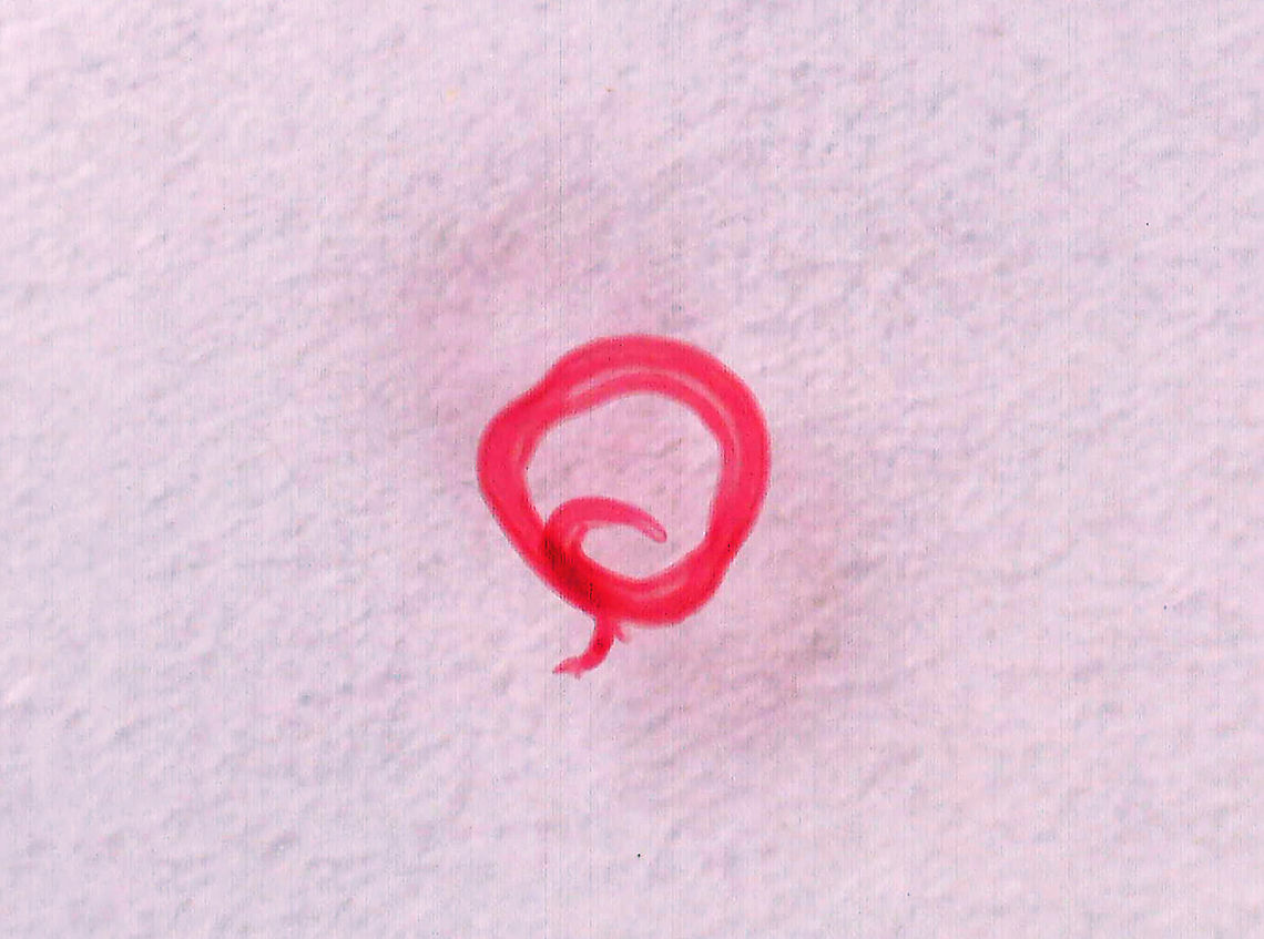 Blood Fluke (Male) - Schistosoma mansoni Schistosoma mansoni is a water-borne parasite in humans. It is the most prevalent parasite in humans and causes intestinal schistosomiasis, which infects over 250 million people worldwide. It is considered to be a Neglected Tropical Disease. Treatment is inexpensive and only costs about US$0.20 per child per year! And yet, treatment is still hard to obtain in poor, developing countries.<br />
<br />
The disease is spread by contact with fresh water contaminated with the parasites, which are released from infected snails. Symptoms include abdominal pain and diarrhea . Long-term, it can cause liver damage, kidney failure, infertility, or bladder cancer. Children are particularly vulnerable because they play in water, which is often contaminated with infected snails.<br />
<br />
*Whole mount slide; this photo was taken at low magnification, just so that I could get a shot of the entire worm.<br />
<figure class="photo"><a href="https://www.jungledragon.com/image/114415/blood_fluke_male_-_schistosoma_mansoni.html" title="Blood Fluke (Male) - Schistosoma mansoni"><img src="https://s3.amazonaws.com/media.jungledragon.com/images/3232/114415_thumb.jpg?AWSAccessKeyId=05GMT0V3GWVNE7GGM1R2&Expires=1770854410&Signature=ydQeWSixuBNJgAlcdi2a2PMDA6k%3D" width="200" height="150" alt="Blood Fluke (Male) - Schistosoma mansoni Schistosoma mansoni is a water-borne parasite in humans. It is the most prevalent parasite in humans and causes intestinal schistosomiasis, which infects over 250 million people worldwide. It is considered to be a Neglected Tropical Disease. Treatment is inexpensive and only costs about US$0.20 per child per year! And yet, treatment is still hard to obtain in poor, developing countries.<br />
<br />
The disease is spread by contact with fresh water contaminated with the parasites, which are released from infected snails.  Symptoms include abdominal pain and diarrhea . Long-term, it can cause liver damage, kidney failure, infertility, or bladder cancer. Children are particularly vulnerable because they play in water, which is often contaminated with infected snails.<br />
<br />
*Whole mount slide<br />
https://www.jungledragon.com/image/114414/blood_fluke_male_-_schistosoma_mansoni.html<br />
https://www.jungledragon.com/image/114413/blood_fluke_male_-_schistosoma_mansoni.html Geotagged,Schistosoma,Schistosoma mansoni,United States,Winter,blood fluke,schistosomiasis,snail fever" /></a></figure><br />
<figure class="photo"><a href="https://www.jungledragon.com/image/114414/blood_fluke_male_-_schistosoma_mansoni.html" title="Blood Fluke (Male) - Schistosoma mansoni"><img src="https://s3.amazonaws.com/media.jungledragon.com/images/3232/114414_thumb.jpg?AWSAccessKeyId=05GMT0V3GWVNE7GGM1R2&Expires=1770854410&Signature=Nes0XCPEXBknT2zwF01VKe1dH1k%3D" width="200" height="150" alt="Blood Fluke (Male) - Schistosoma mansoni Schistosoma mansoni is a water-borne parasite in humans. It is the most prevalent parasite in humans and causes intestinal schistosomiasis, which infects over 250 million people worldwide. It is considered to be a Neglected Tropical Disease. Treatment is inexpensive and only costs about US$0.20 per child per year! And yet, treatment is still hard to obtain in poor, developing countries.<br />
<br />
The disease is spread by contact with fresh water contaminated with the parasites, which are released from infected snails. Symptoms include abdominal pain and diarrhea . Long-term, it can cause liver damage, kidney failure, infertility, or bladder cancer. Children are particularly vulnerable because they play in water, which is often contaminated with infected snails.<br />
<br />
*Whole mount slide<br />
https://www.jungledragon.com/image/114415/blood_fluke_male_-_schistosoma_mansoni.html<br />
https://www.jungledragon.com/image/114413/blood_fluke_male_-_schistosoma_mansoni.html Geotagged,Schistosoma mansoni,United States,Winter" /></a></figure> Geotagged,Schistosoma mansoni,United States