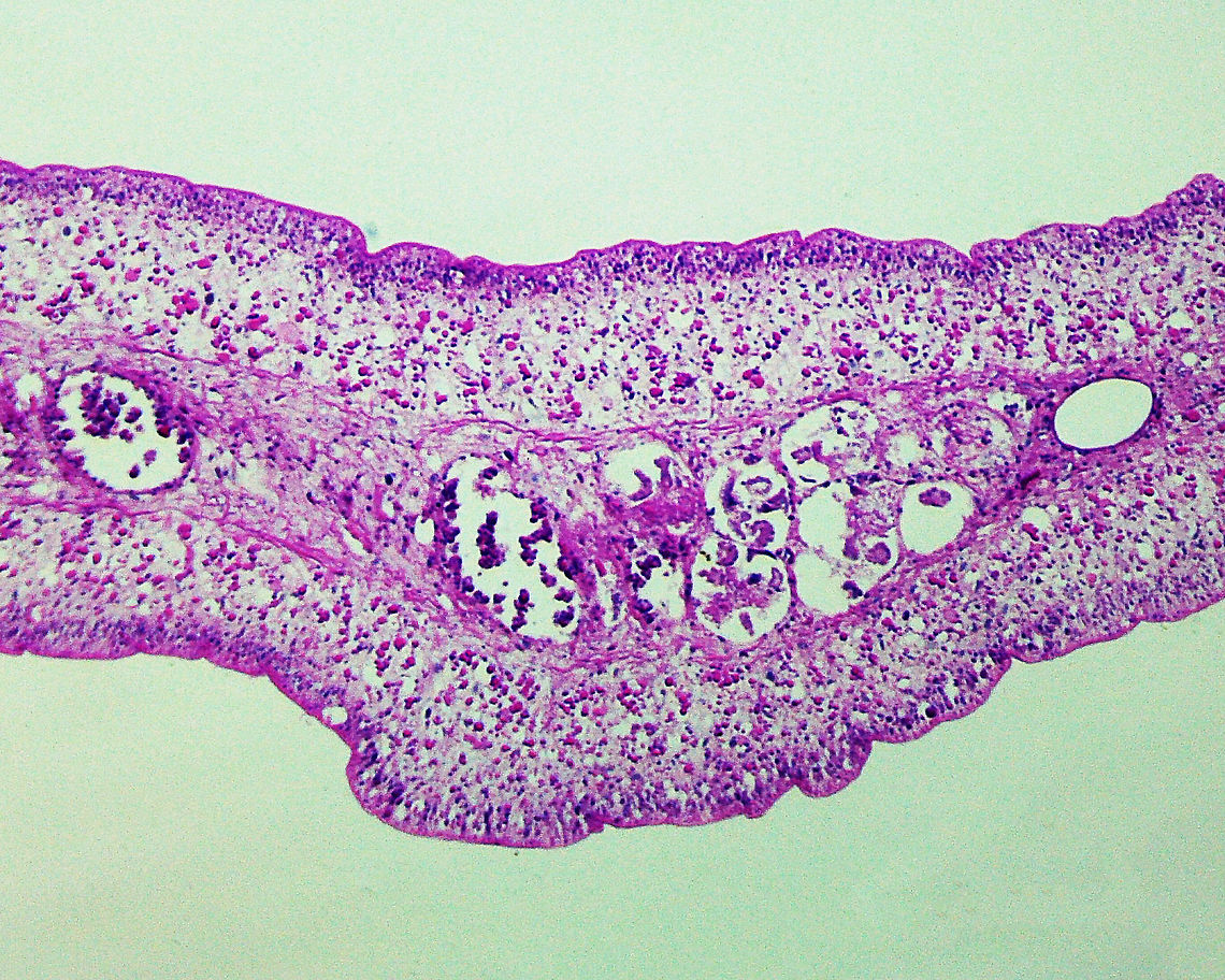 Beef Tapeworm - Taenia saginata The beef tapeworm is a zoonotic parasite in which cattle are the intermediate hosts (where larval development occurs) and humans are definitive hosts (harboring the adult worms).<br />
<br />
This tapeworm causes taeniasis in humans, which is often asymptomatic. But, a heavy infection can cause weight loss, abdominal pain, diarrhea, nausea, chronic indigestion, etc. Intestinal obstruction is a severe consequence of infection. Most infections clear up in 2-3 years without treatment.<br />
<br />
*Cross-section microscope slide<br />
<figure class="photo"><a href="https://www.jungledragon.com/image/115020/beef_tapeworm_-_taenia_saginata.html" title="Beef Tapeworm - Taenia saginata"><img src="https://s3.amazonaws.com/media.jungledragon.com/images/3232/115020_thumb.jpg?AWSAccessKeyId=05GMT0V3GWVNE7GGM1R2&Expires=1759968010&Signature=2rXc5tEbpdrjKI8IyCHbHHPlNyY%3D" width="200" height="150" alt="Beef Tapeworm - Taenia saginata The beef tapeworm is a zoonotic parasite in which cattle are the intermediate hosts (where larval development occurs) and humans are definitive hosts (harboring the adult worms).<br />
<br />
This tapeworm causes taeniasis in humans, which is often asymptomatic. But, a heavy infection can cause weight loss, abdominal pain, diarrhea, nausea, chronic indigestion, etc. Intestinal obstruction is a severe consequence of infection. Most infections clear up in 2-3 years without treatment.<br />
<br />
*Cross-section microscope slide<br />
https://www.jungledragon.com/image/115023/beef_tapeworm_-_taenia_saginata.html Geotagged,Taenia,Taenia saginata,United States,beef tapeworm,intestinal parasite,taeniasis,tapeworm,zoonosis" /></a></figure> Beef Tapeworm,Geotagged,Taenia saginata,United States,Winter