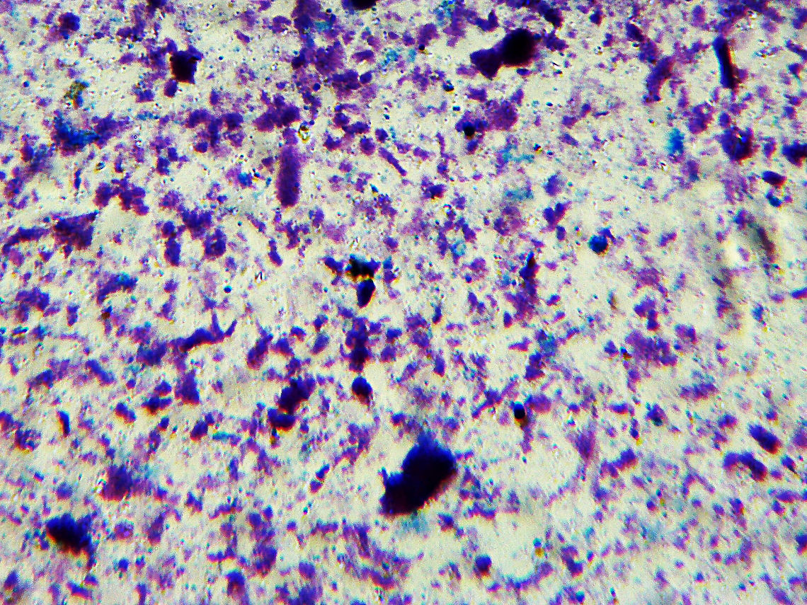 Tuberculosis - Mycobacterium tuberculosis Mycobacterium tuberculosis is the agent that causes tuberculosis in humans.  It is an airborne disease that infects the respiratory system.  It easily gets passed by sneezing, coughing, and talking. <br />
<br />
It is currently the deadliest infectious agent worldwide, affecting nearly 2 billion people.<br />
<br />
*Microscope slide, w.m. Mycobacteriaceae,Mycobacterium tuberculosis,bacteria,mycobacterium tuberculosis,pathogen,pathogenic bacteria,tuberculosis