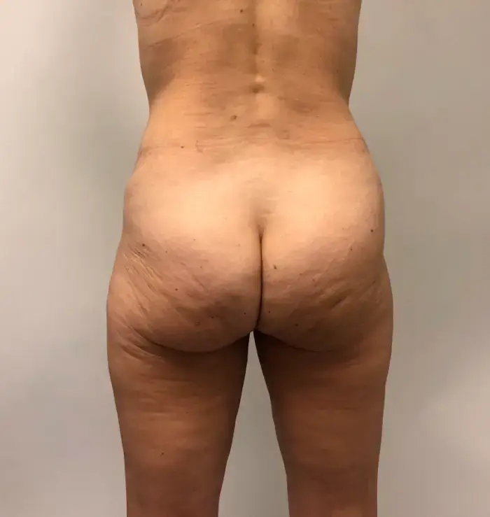 before and after bbl back view