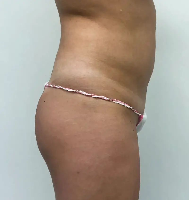 before and after bbl side view
