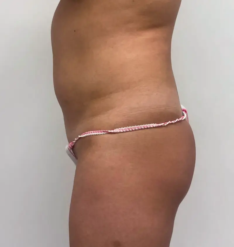 before and after bbl side view