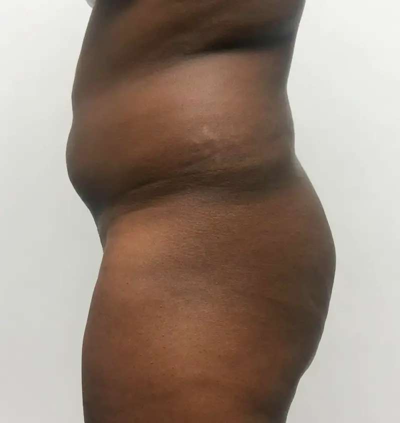 before and after bbl side view