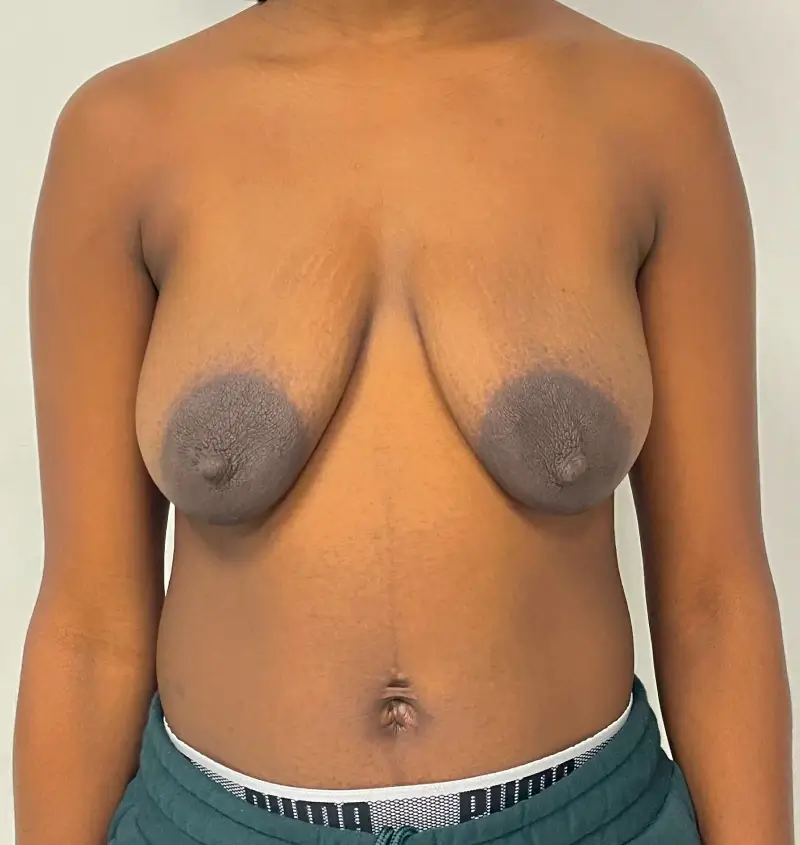 before and after breast augmentation front view