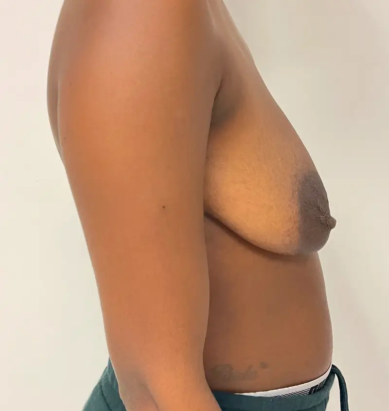 before and after breast augmentation side view