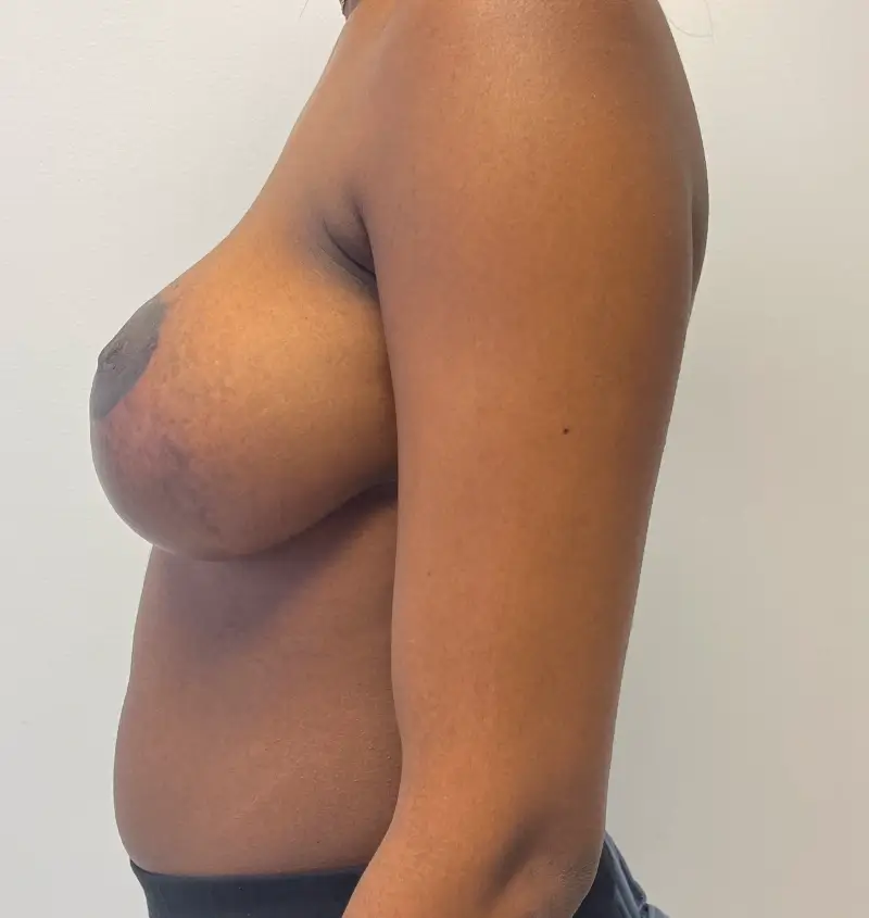 before and after breast augmentation side view