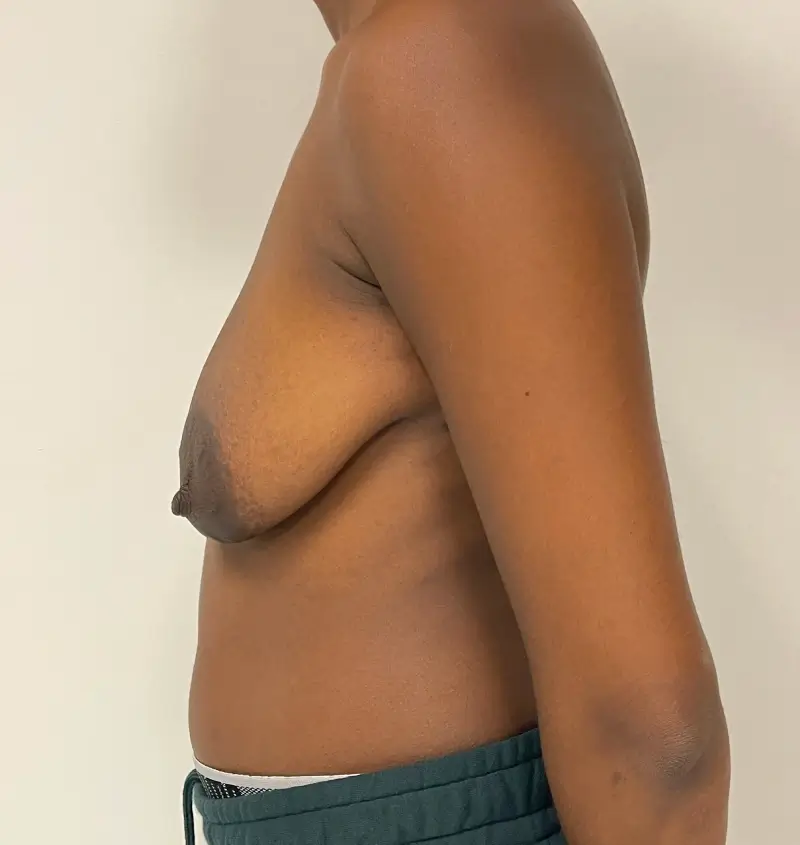 before and after breast augmentation side view