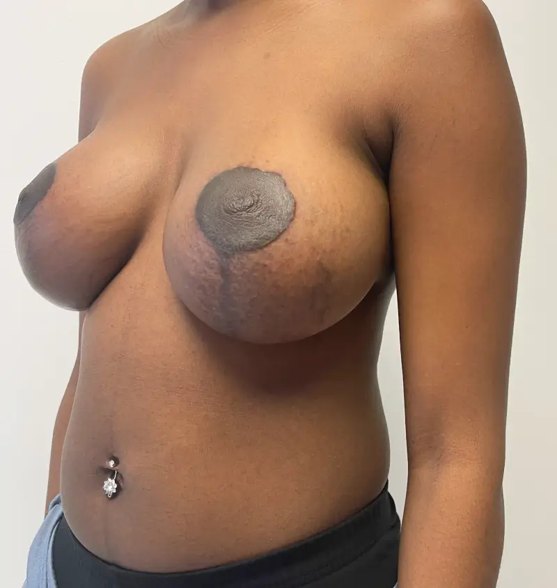before and after breast augmentation angle view