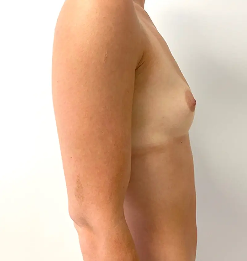 before and after breast augmentation side view