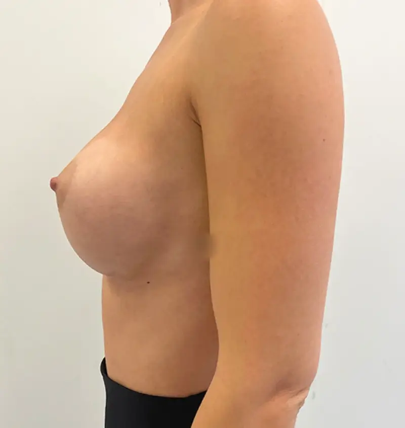 before and after breast augmentation side view