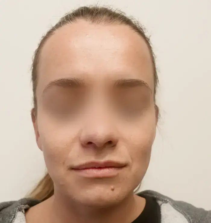before and after otoplasty front view
