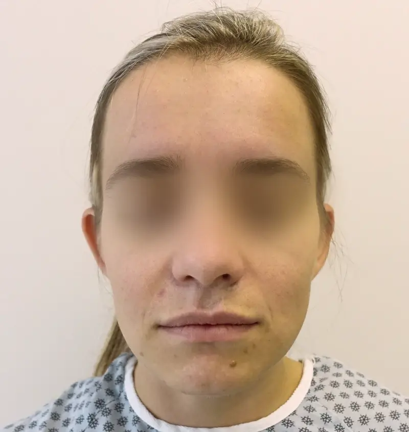 before and after otoplasty front view