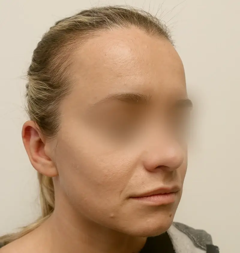 before and after otoplasty angle view