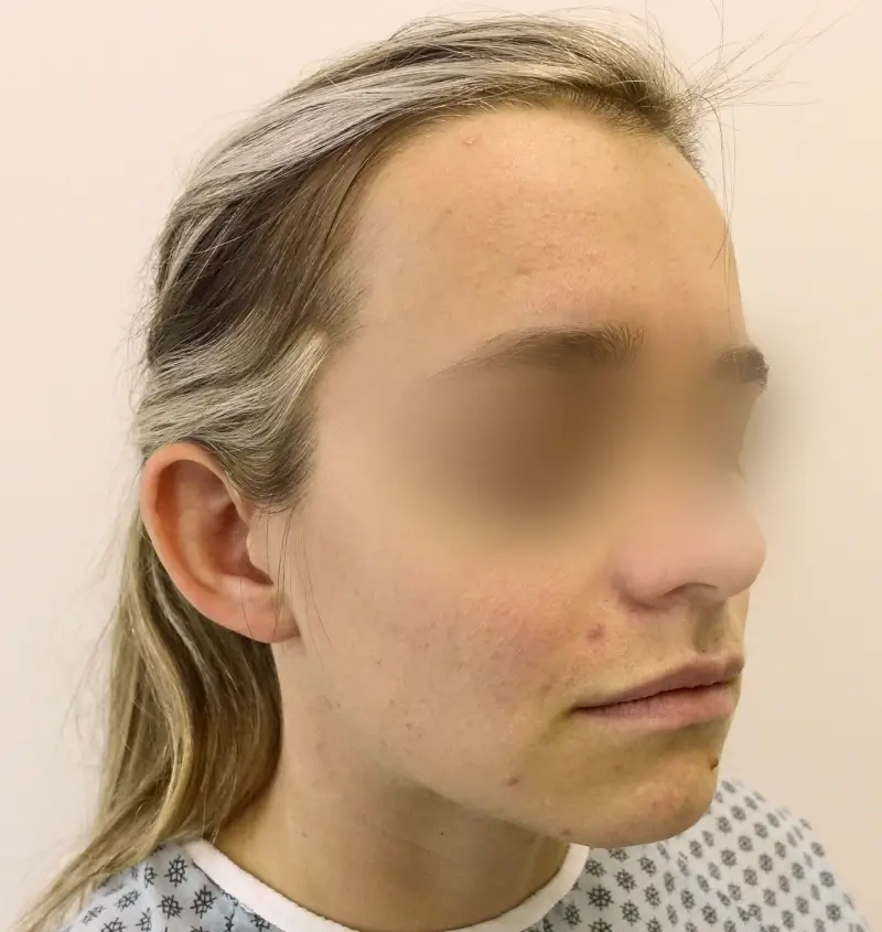 before and after otoplasty angle view