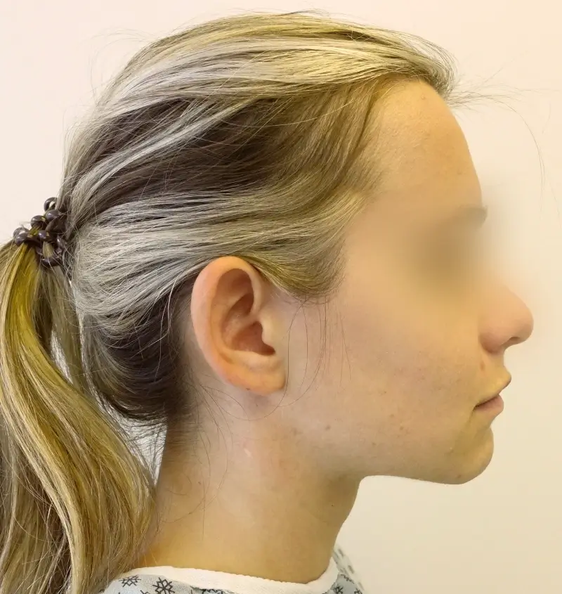 before and after otoplasty side view
