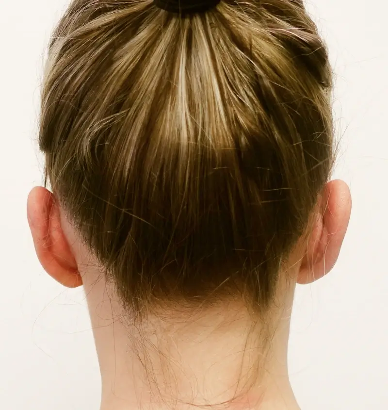 before and after otoplasty back view