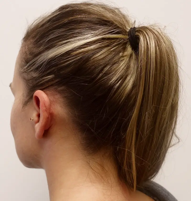 before and after otoplasty angle view