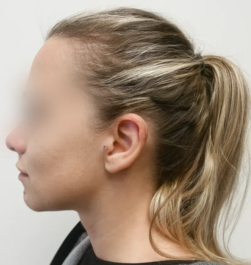 before and after otoplasty side view