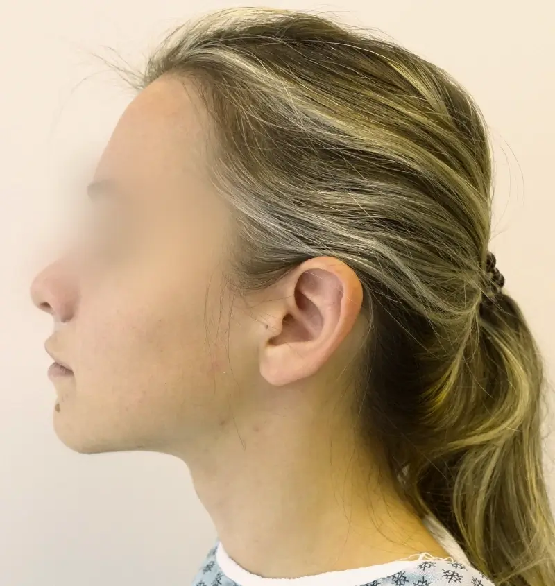 before and after otoplasty side view