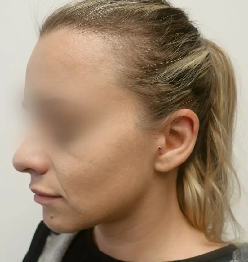 before and after otoplasty angle view